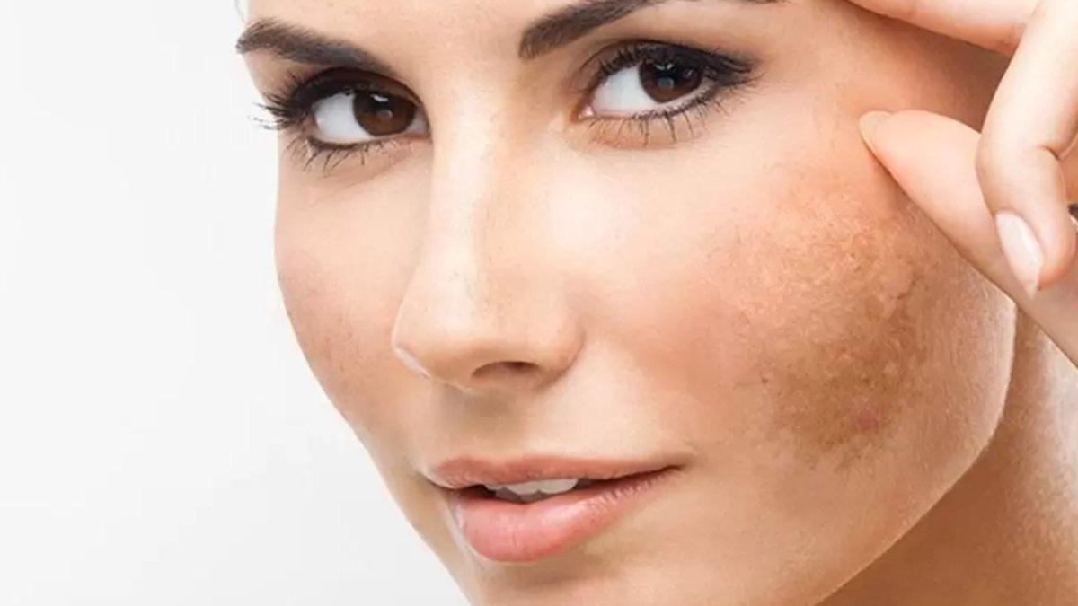 Munculnya melasma di kulit