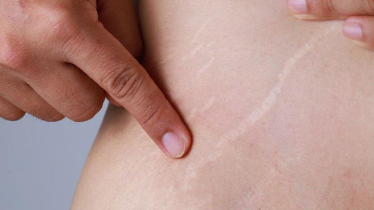 Stretch Mark muncul di kulit