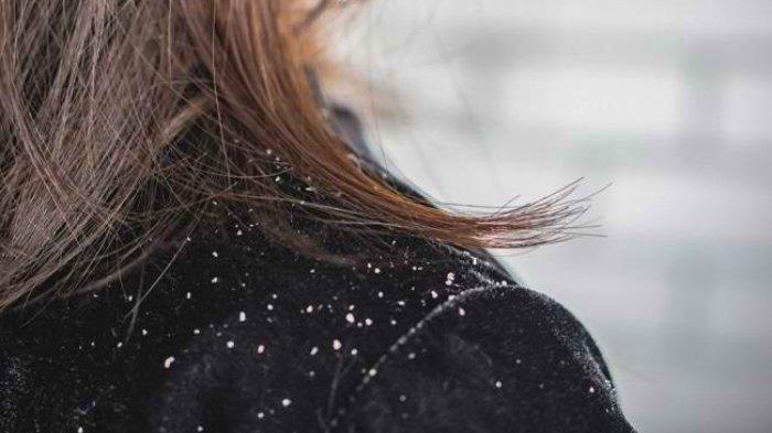 7 Bahan Alami Ini Bisa Membasmi Ketombe di Rambut yang Mudah Rontok di Baju
