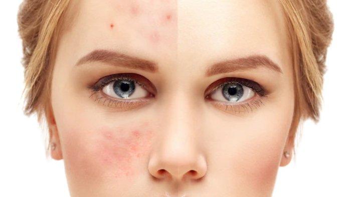 Tanda skin barrier rusak.