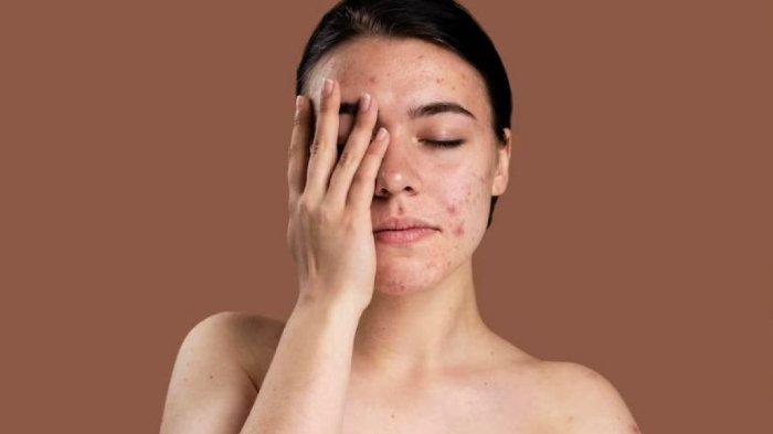 Ilustrasu skin barrier rusak, bisa membuat kulit jadi mudah breakout.