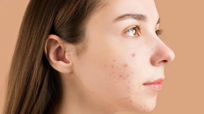 Ilustrasi wanita yang memiliki Bekas Jerawat pada Wajah, bisa dihilangkan dengan skincare mengandung tranexamic acid.