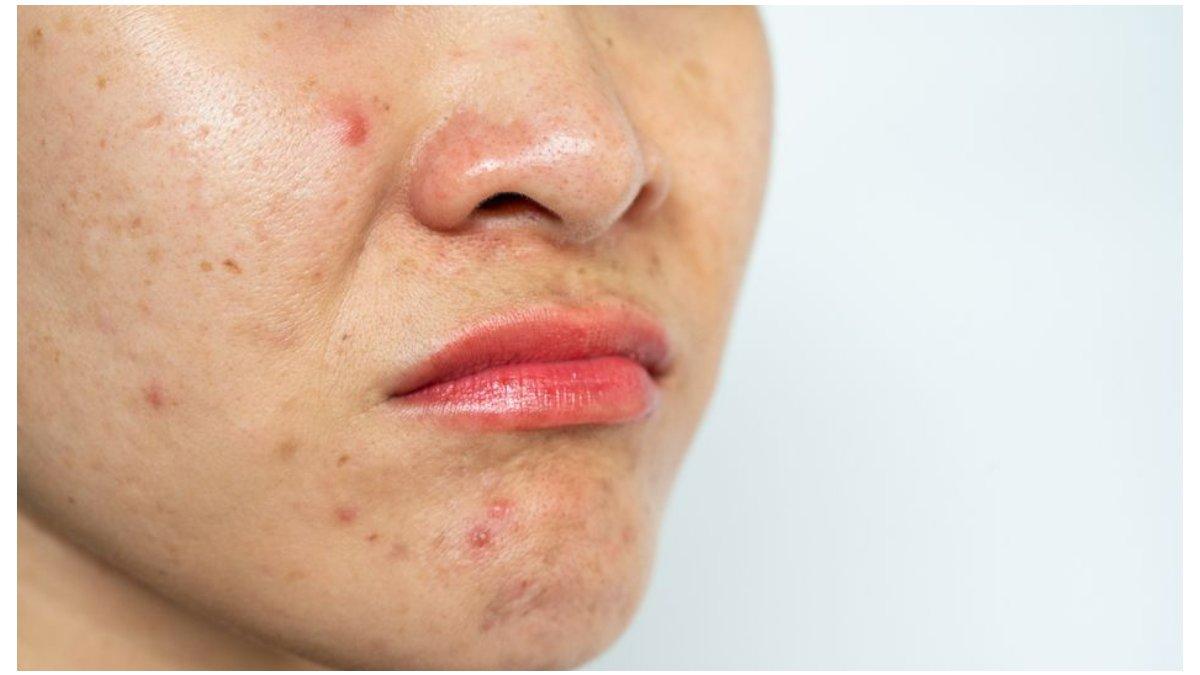 Ilustrasi bekas jerawat bisa kamu atasi dengan menggunakan skincare yang mengandung retinol.