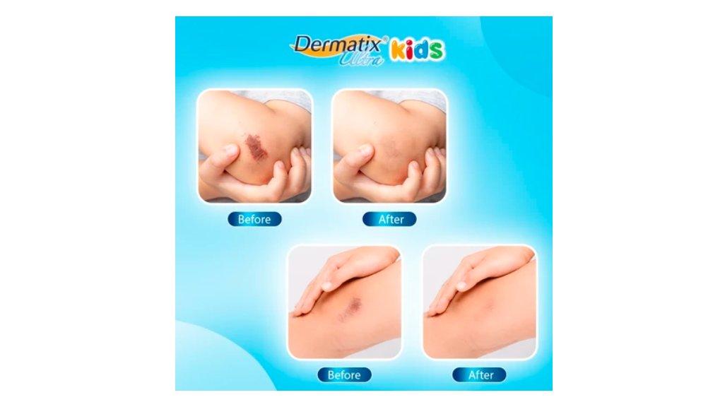 Dermatix Ultra Kids