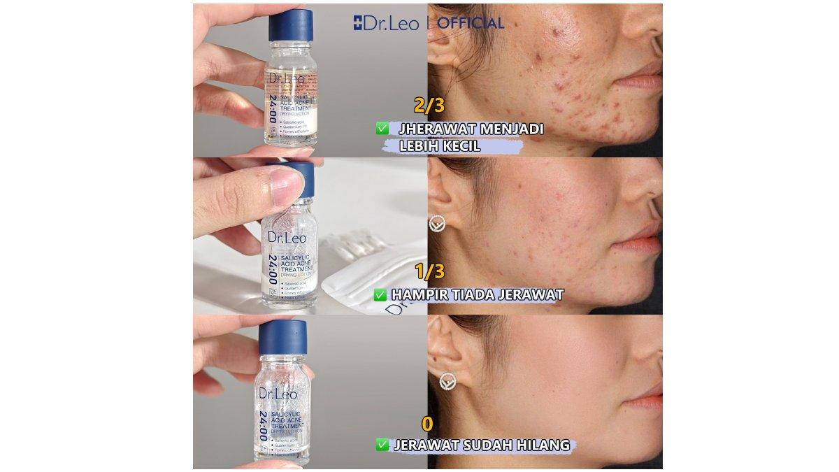 Dr.Leo Salicylic Acid Acne Drying Lotion