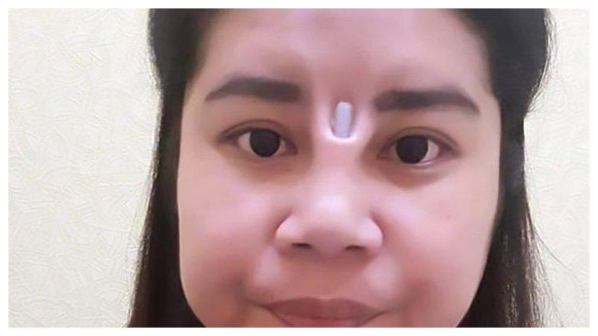 Ilustrasi pengalaman seseorang yang Gagal Implan hidung.