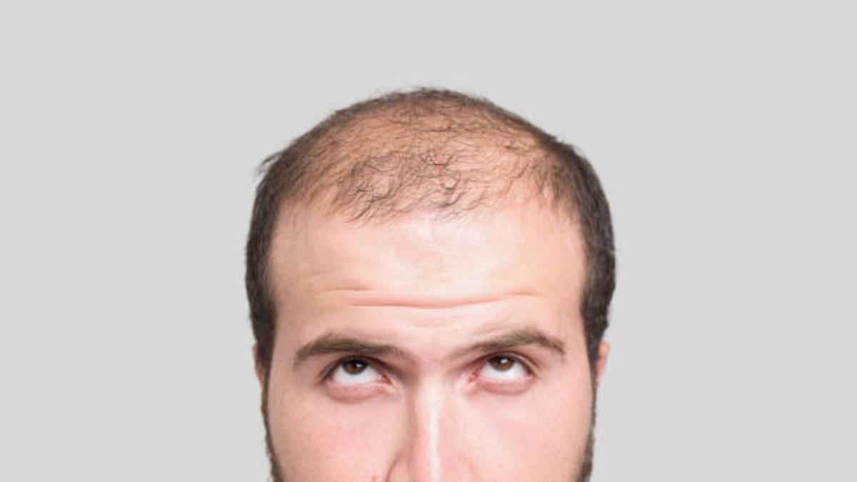 Pria yang mulai mengalami kebotakan.