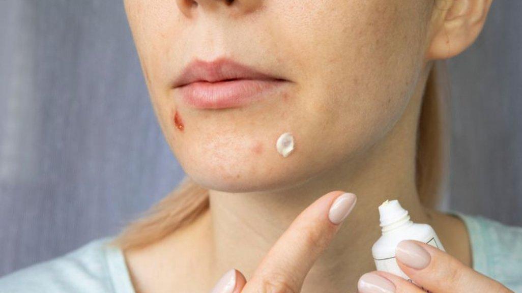 Ilustrasi aplikasi obat totol jerawat