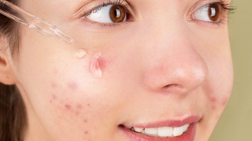 Skincare dengan kandungan anti-inflamasi jadi pilihan paling tepat untuk bantu atasi jerawat meradang (kompas.com)
