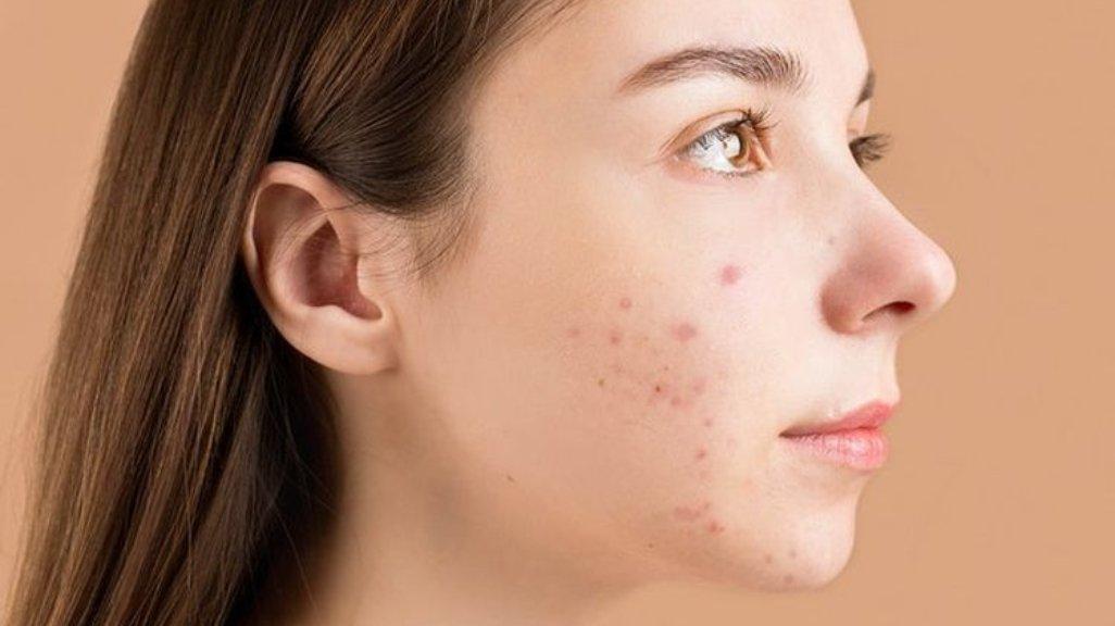 Hyaluronic Acid mampu jadi solusi pemilik kulit sensitif dan berjerawat (kompas.com)