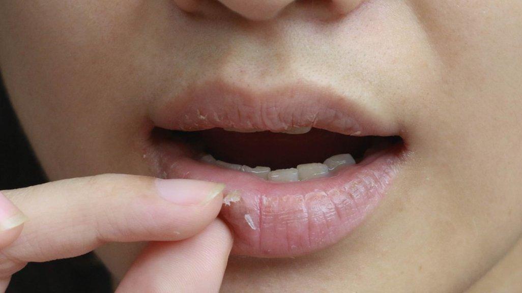 Ilustrasi mengopek permukaan bibir