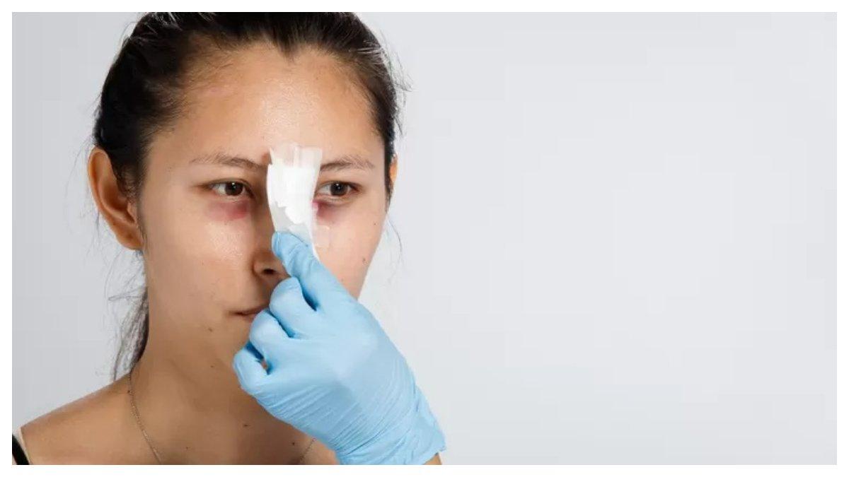 Ilustrasi penyumbatan pembulu darah pada hidung