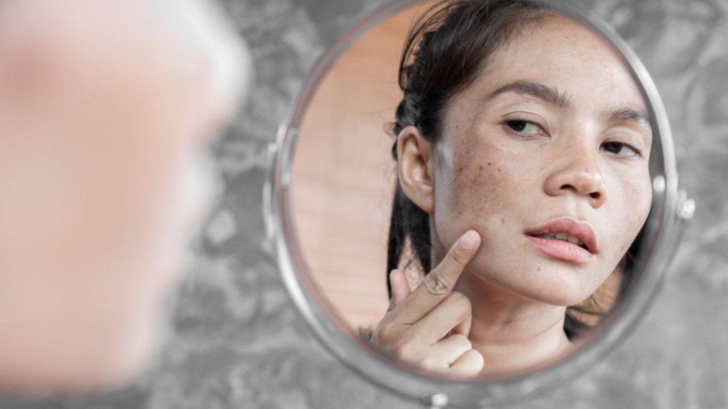 Melasma bisa jadi makin sulit dihilangkan bila tak segera ditangani dengan tepat (grid.id)