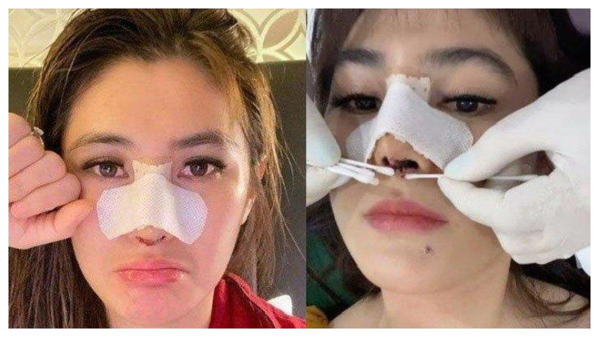 Ilustrasi risiko reabsorpsi operasi hidung