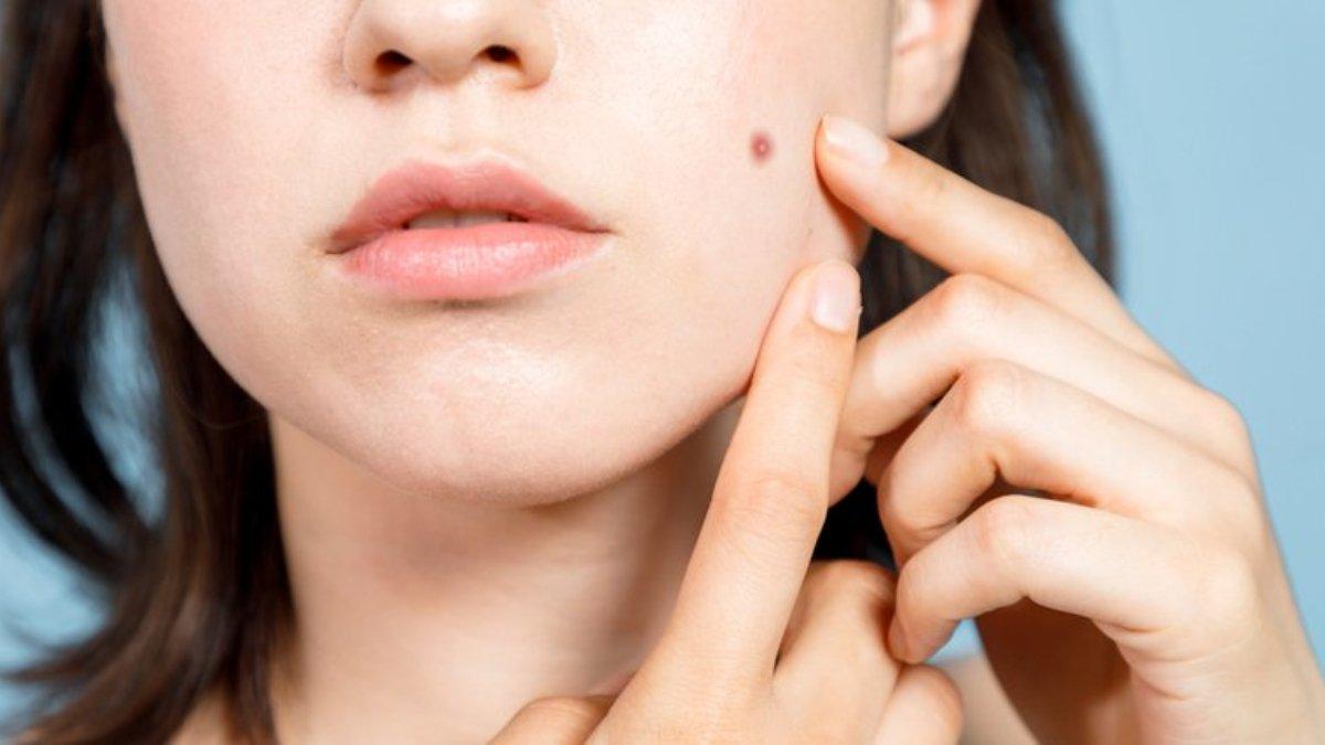 Ilustrasi wanita yang memiliki bekas jerawat di wajah, bisa diatasi dengan rajin menggunakan retinol.