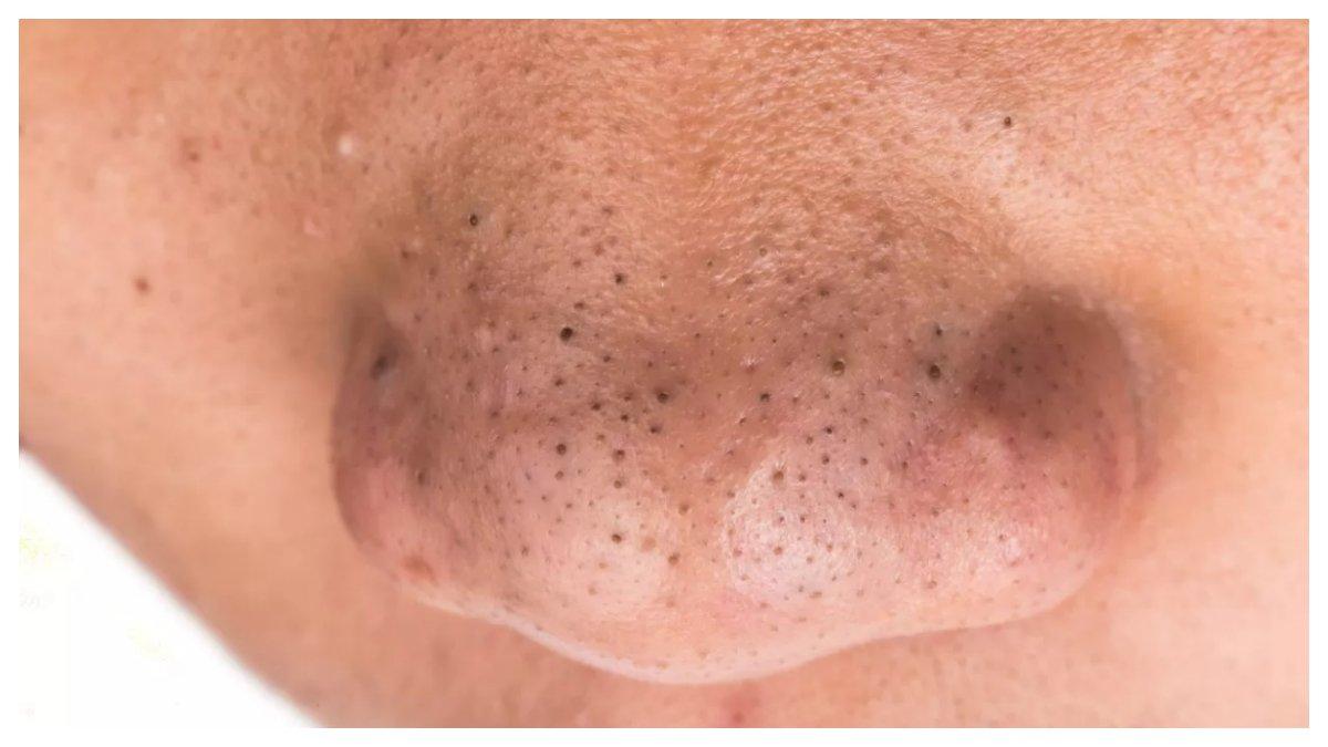 Komedo hitam mengganggu penampilan bisa diatasi dengan clay mask.