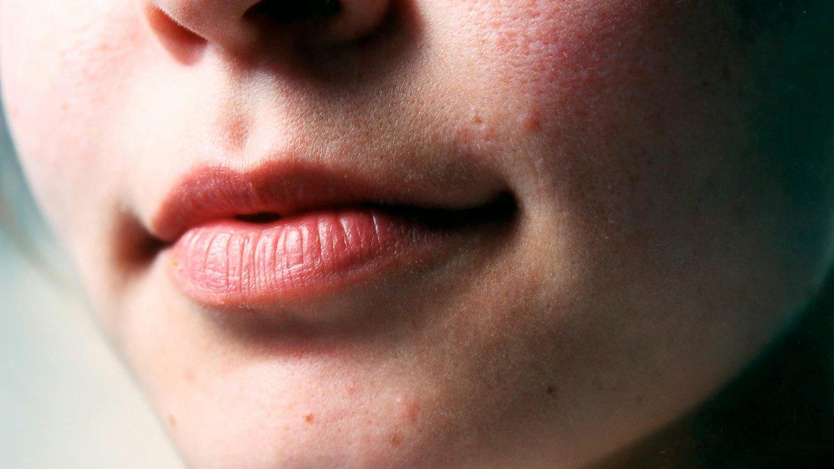 Madu bisa membantu menyembuhkan bibir pecah-pecah.