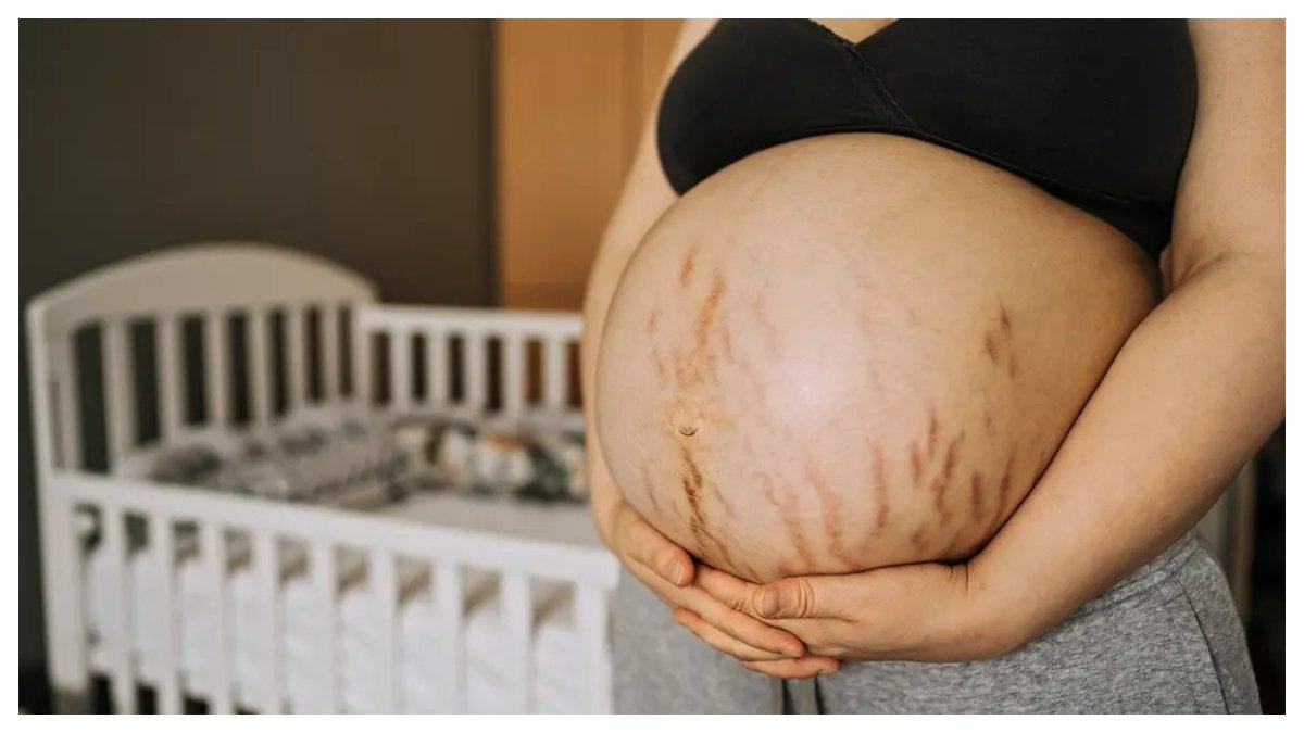 Stretch mark di masa kehamilan.