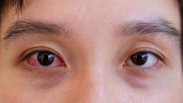 Air rebusan ketumbar bisa mencegah konjungtivitis.