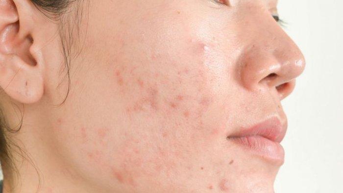 Ilustrasi masalah jerawat di wajah