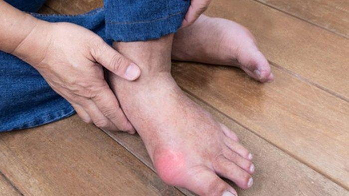Ilustrasi kaki bengkak.
