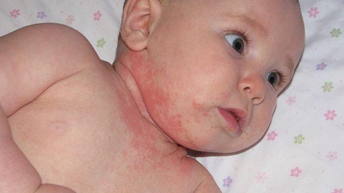 Biang keringat pada bayi.