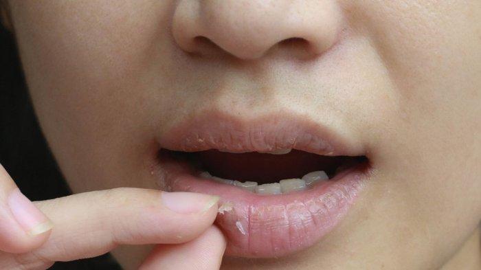 Ilustrasi wanita dengan masalah bibir kering dan pecah-pecah.