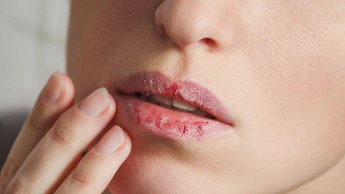 Seorang wanita dengan kondisi bibir kering dan pecah-pecah