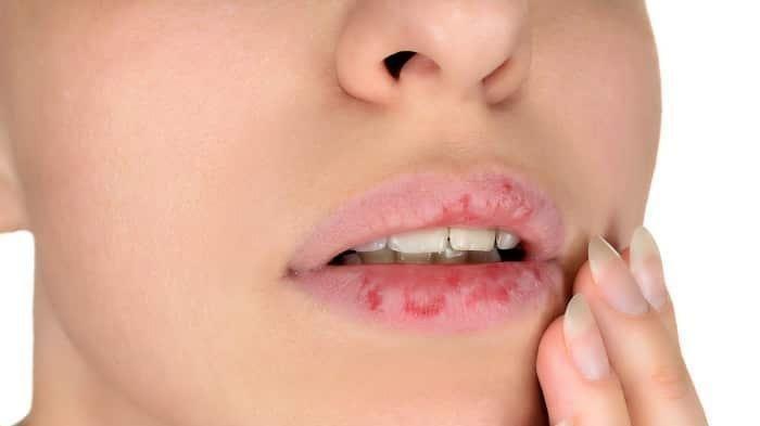 Ilustrasi bibir kering dan pecah-pecah.