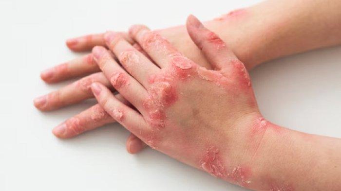 Buah pinang juga bisa kamu gunakan sebagai Obat Kudis