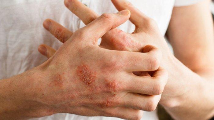 Ilustrasi seseorang terkena dermatitis kontak.