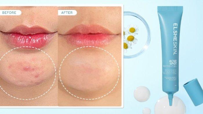 ElsheSkin Acne Spot Treatment Gel 