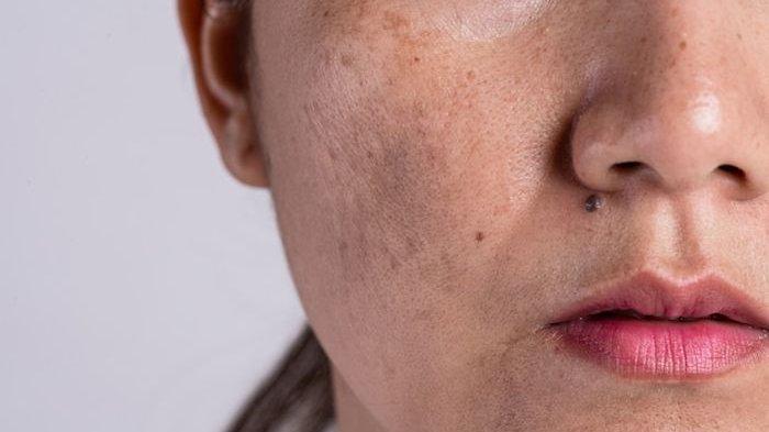 Flek hitam di wajah yang menganggu penampilan ini bisa kamu atasi dengan menggunakan masker dari biji selasih.