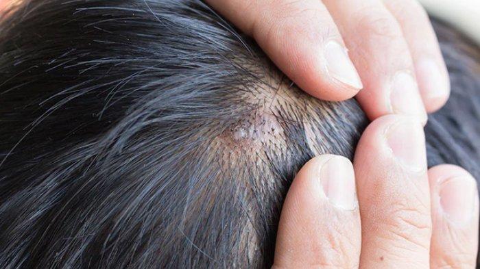 Peradangan pada kulit kepala bisa disembuhkan dengan menggunakan minyak lavender.