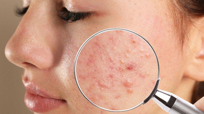 Ilustrasi kulit wajah berjerawat, harus jeli memilih skincare yang tepat.