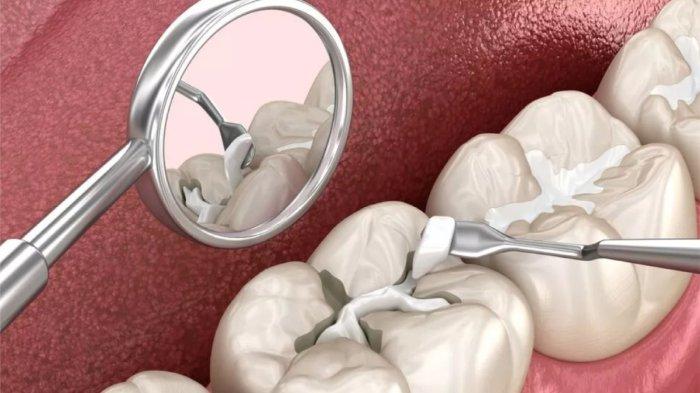 Ilustrasi menambal gigi berlubang.