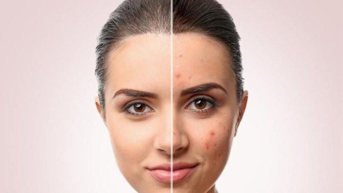 Ilustrasi malas membersihkan make up bisa membuat kulit berjerawat