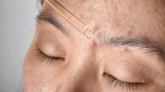 Ilustrasi mengaplikasikan serum terbaik untuk kulit berjerawat.