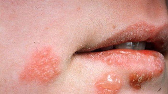 Ilustrasi seorang wanita yang kurang percaya diri karena herpes di wajah