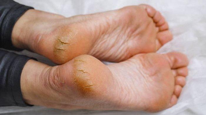 Ilustrasi tumit kaki dengan kondisi kering dan pecah-pecah yang mengganggu penampilan