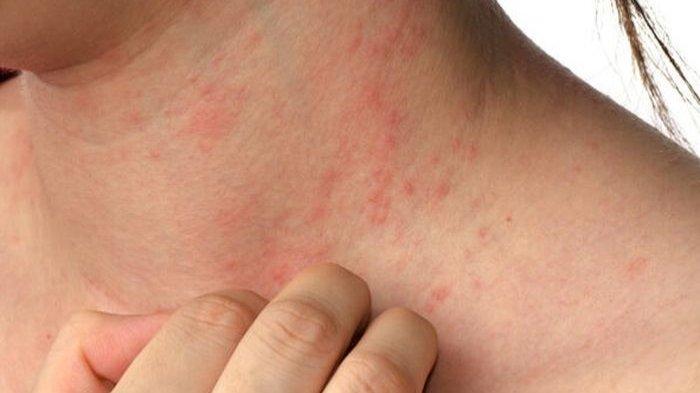 Ilustrasi seseorang terkena infeksi pada kulit. 