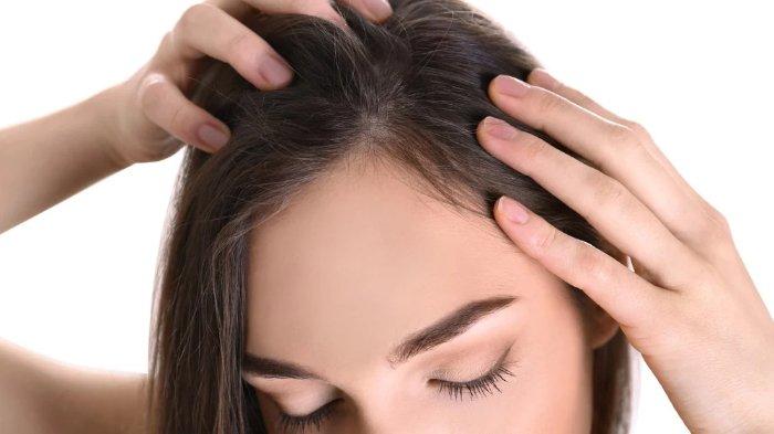 Ilustrasi rambut rontok, bisa diatasi dengan bahan alami kayu manis.