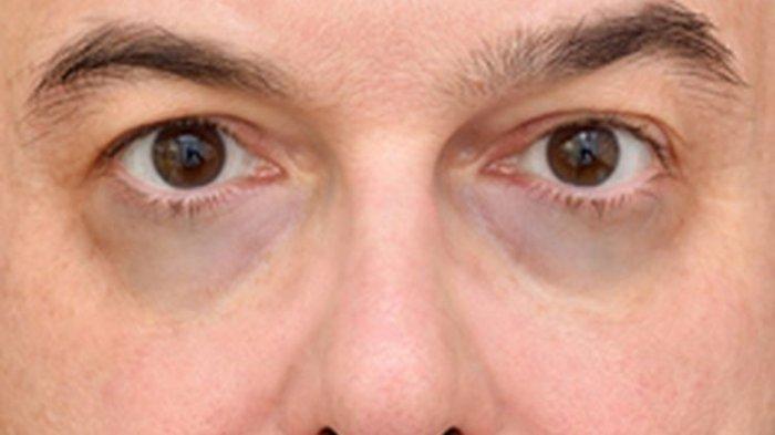 Munculnya lingkaran mata hitam bisa diatasi dengan menggunakan serum yang mengandung vitamin C.
