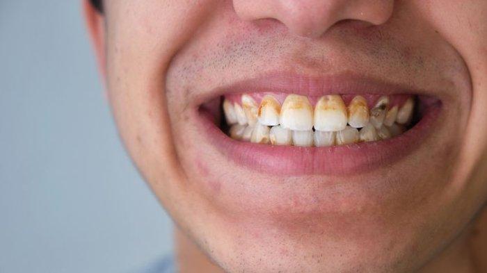 Gigi kuning dan keropos karena terlalu sering minum kopi.