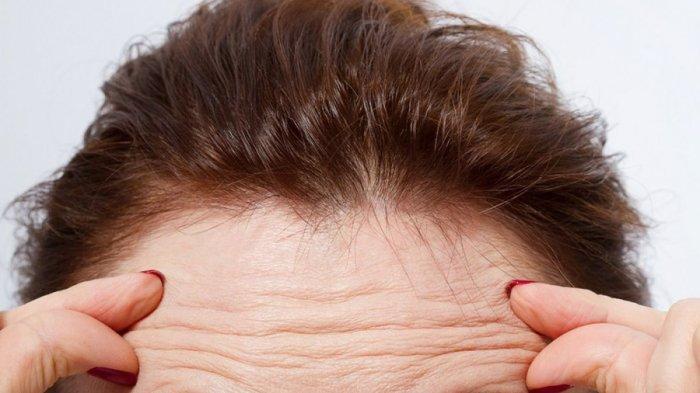 Keriput yang muncul di dahi 