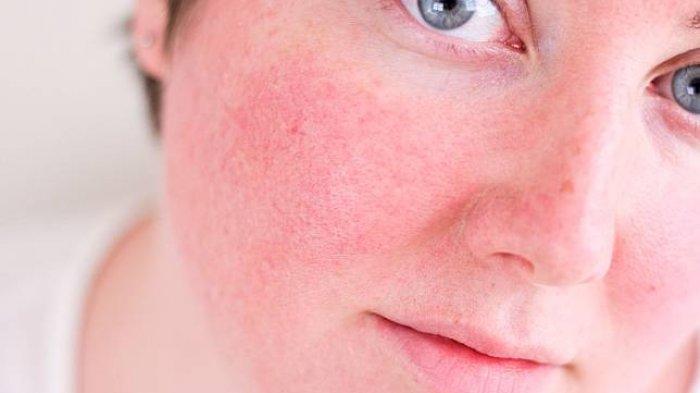 Reaksi tidak wajar menggunakan skincare