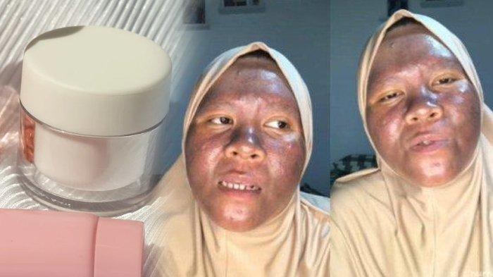 Ilustrasi efek penyakit Okronosis Eksogen