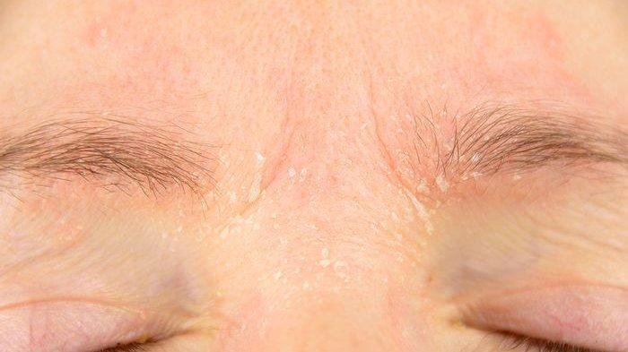 Ilustrasi kulit wajah jadi sangat kering karena tidak cocok dengan kandungan hidrokuinon yang ada di dalam produk kosmetik.