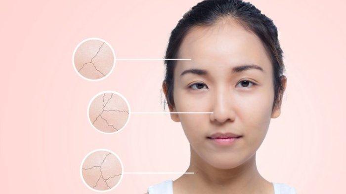 Ilustrasi kulit wajah kering karena menggunakan skincare mengandung benzoil per