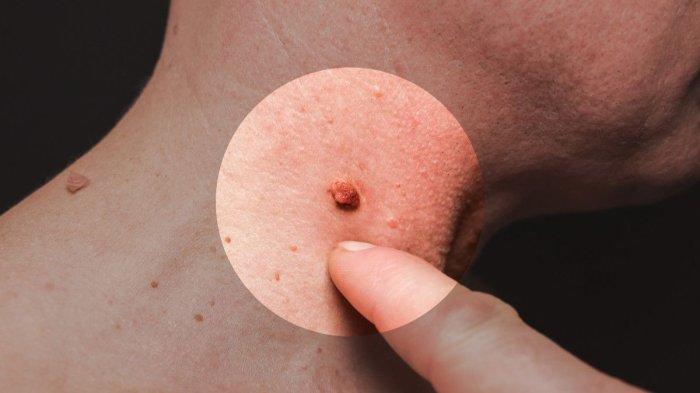 kutil bisa diatasi dengan bahan alami termasuk kulit pisang.